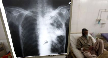 ¿Lamentable: 30% de los pacientes con Covid-19 tienen secuelas pulmonares por un año