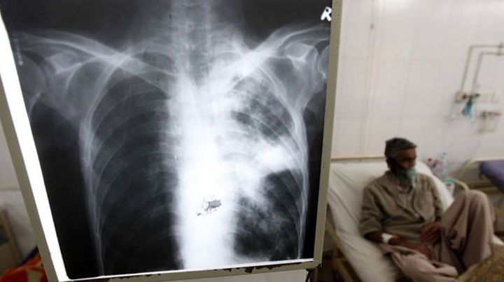 ¿Lamentable: 30% de los pacientes con Covid-19 tienen secuelas pulmonares por un año