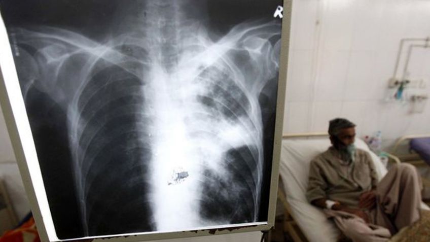 ¿Lamentable: 30% de los pacientes con Covid-19 tienen secuelas pulmonares por un año