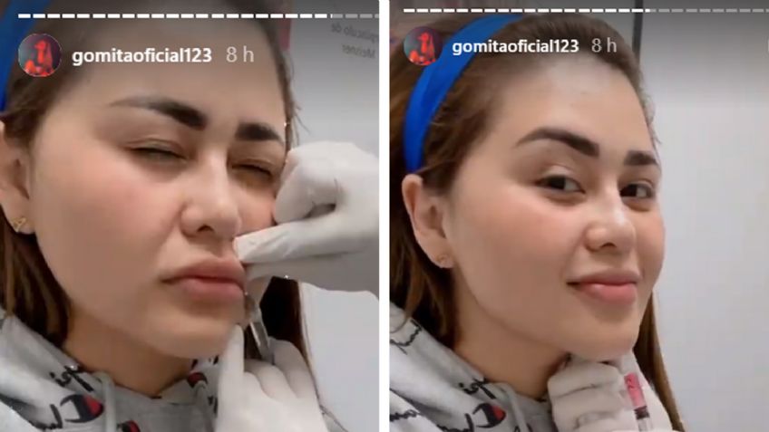Pese a fuertes críticas, 'Gomita' se somete a nuevo procedimiento estético en el rostro