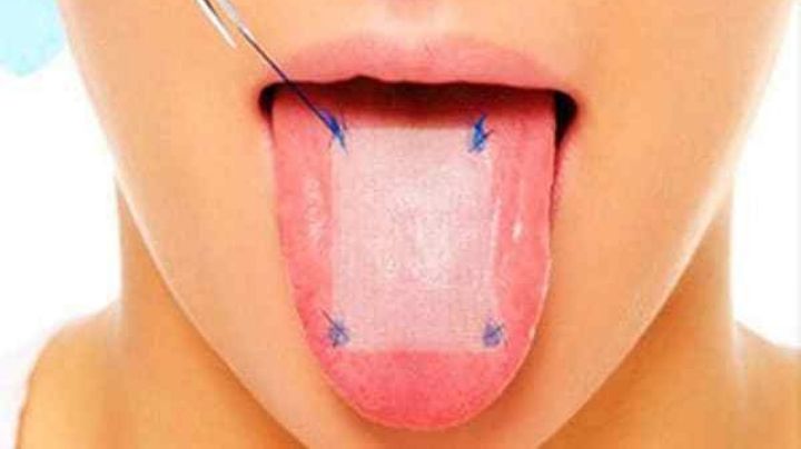 ¡Ten cuidado! Conoce todo sobre la malla lingual, el método doloroso para bajar de peso
