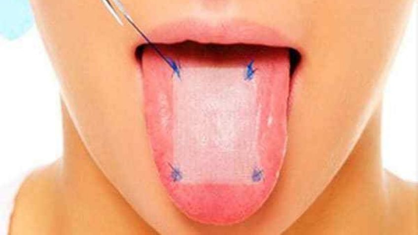 ¡Ten cuidado! Conoce todo sobre la malla lingual, el método doloroso para bajar de peso