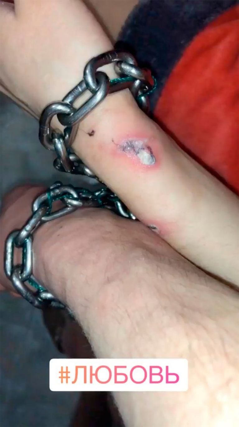 Pareja sufre úlceras en la piel por atarse con una cadena