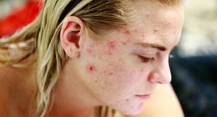 Estas son algunas de las razones por las que el acné aparece después de los 25 años