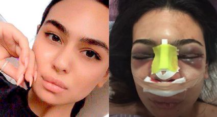 FOTOS: Karolina se sometió a una cirugía de nariz y casi pierde la vida; así se ve ahora
