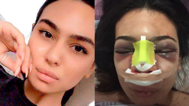 FOTOS: Karolina se sometió a una cirugía de nariz y casi pierde la vida; así se ve ahora