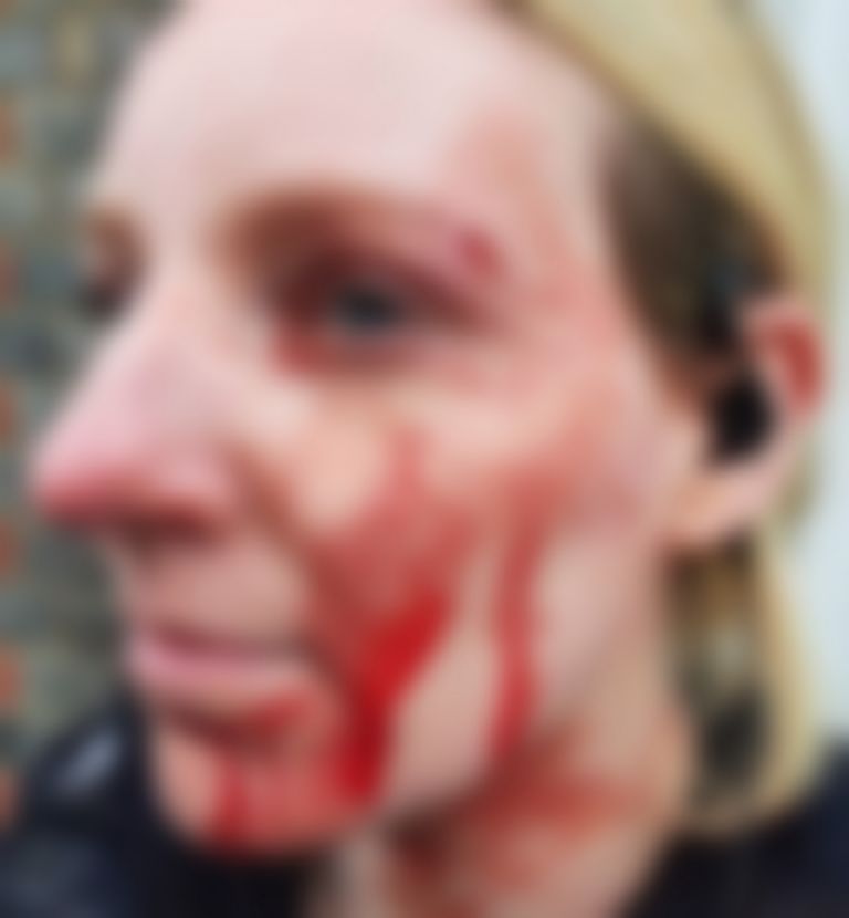 Kerri Trickey sufrió una herida en la ceja