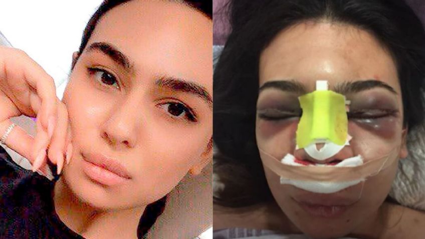 FOTOS: Karolina se sometió a una cirugía de nariz y casi pierde la vida; así se ve ahora