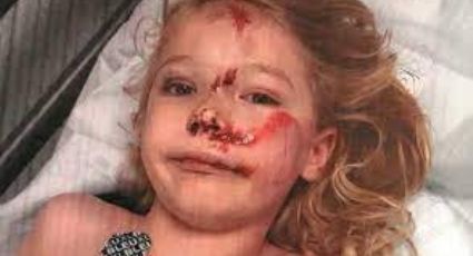 Trágico accidente: Arrollan a niño de 6 años con un e-scooter; le desfiguraron el rostro