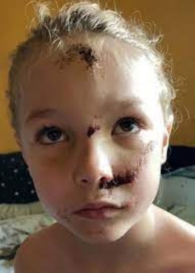 Jamie Smith sobrevivió a un fuerte accidente con un e-scooter