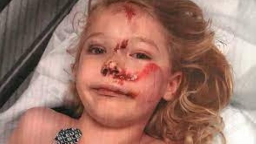 Trágico accidente: Arrollan a niño de 6 años con un e-scooter; le desfiguraron el rostro