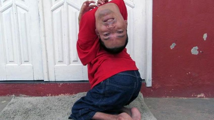 "Es muy agresivo": Aumenta la letalidad del coronavirus en hombre con cabeza al revés