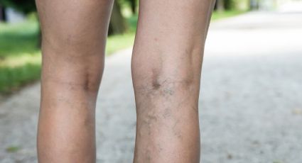 ¡Actívate! Estos ejercicios te ayudarán a prevenir las varices en las piernas