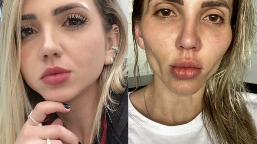 Influencer brasileña se desfigura el rostro tras realizarse una cirugía plástica