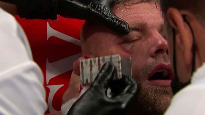 ¡De no creerse! Saunders está en el hospital; asevera que 'Canelo' le rompió en 3 la mejilla