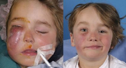 Niño de 4 años sufre parálisis facial tras ser mordido por una cobra escupidora en la cara