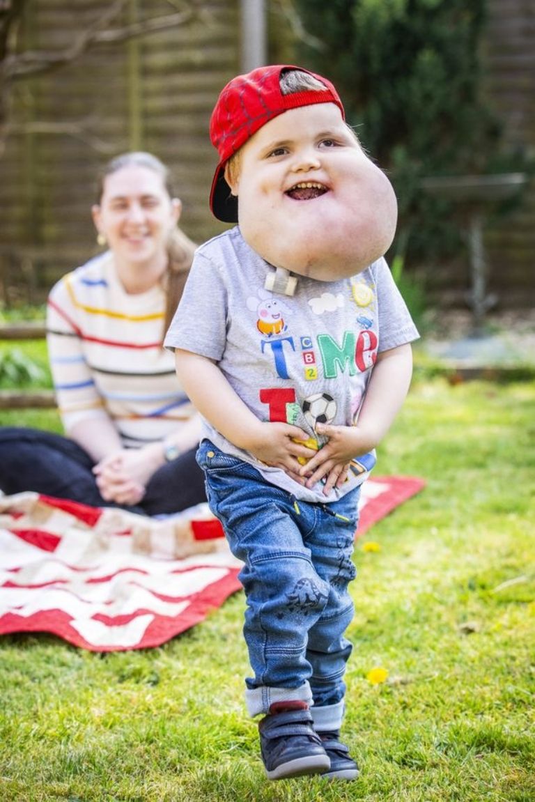 Alex Grabowski nació con un quiste del tamaño de una toronja