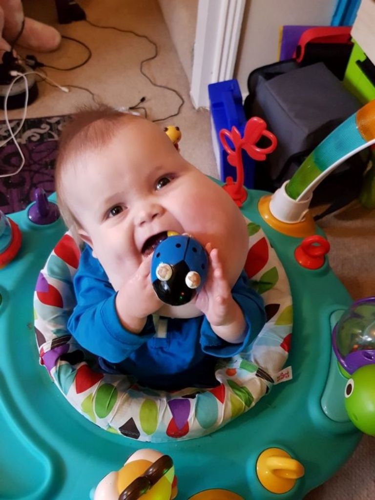 Alex Grabowski nació con un quiste del tamaño de una toronja