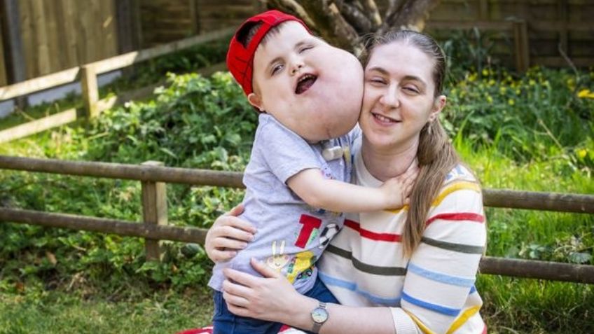 FOTOS: Él es Alex, el niño que nació con un quiste en la cara del tamaño de una toronja