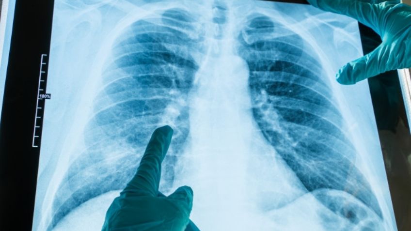 Covid-19: La neumonía bilateral sería la secuela más temida causada por el virus