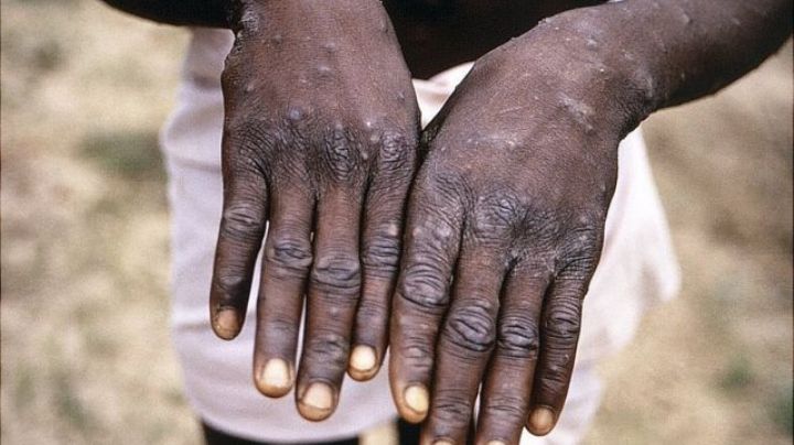 Conoce qué es la viruela del simio, la enfermedad detectada en el Reino Unido