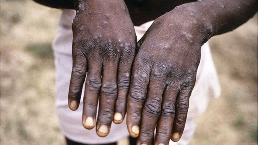 Conoce qué es la viruela del simio, la enfermedad detectada en el Reino Unido