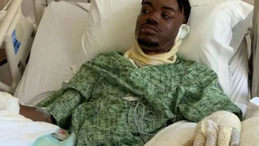 Una mujer incendia la cabeza de su esposo en venganza por unas alitas de pollo