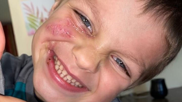 Niño de 5 años termina desfigurado tras ser brutalmente atacado por el perro de su niñera