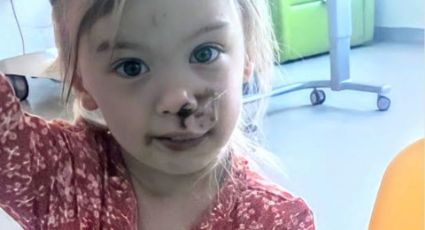 Marcada de por vida: Niña de 2 años es brutalmente mordida en la cara por un perro