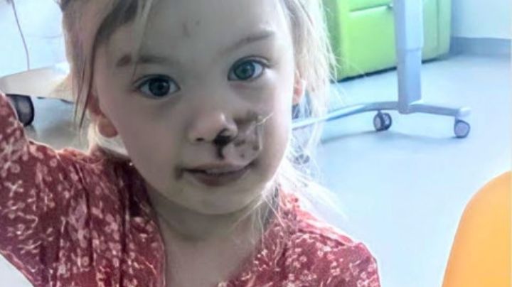 Marcada de por vida: Niña de 2 años es brutalmente mordida en la cara por un perro