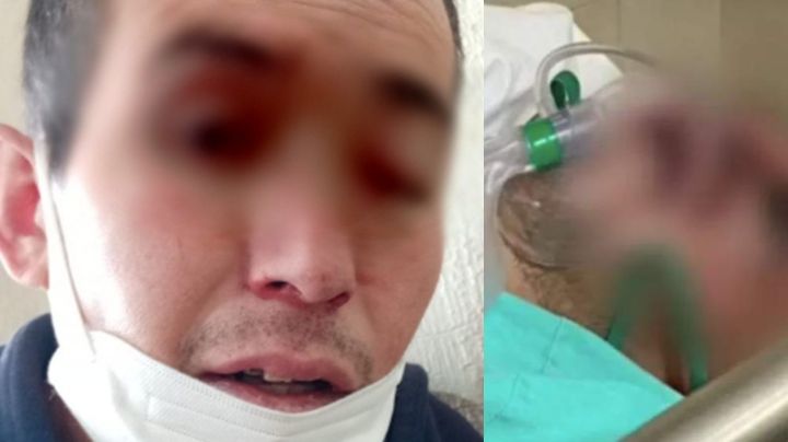 ¡Alerta en México! Muere Gregorio, primer caso post Covid-19 de hongo negro; tenía 34 años