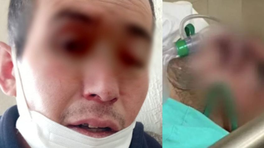 ¡Alerta en México! Muere Gregorio, primer caso post Covid-19 de hongo negro; tenía 34 años