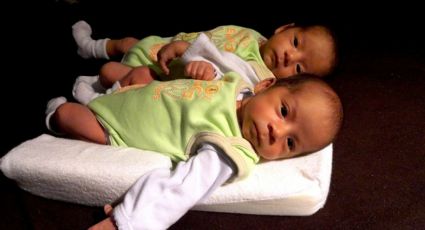 FOTO: ¡Impactante! Tras nacer unidas de la cabeza, unas gemelas son sometidas a una rara cirugía