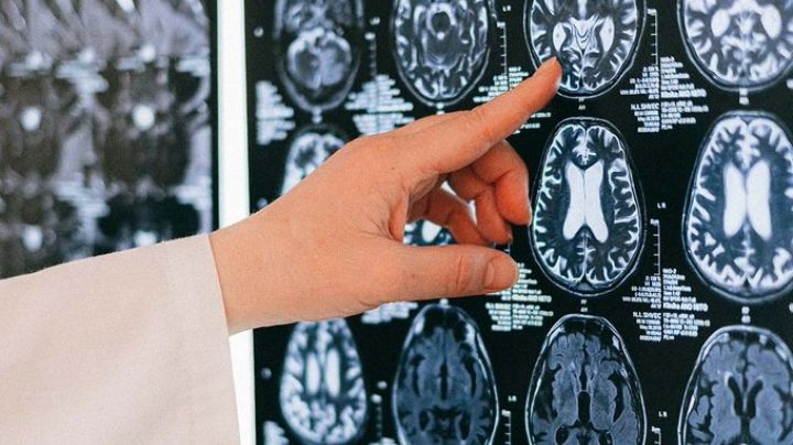 ¿Es alarmante? Estudio asegura que pacientes que tuvieron Covid-19 presentan reducción de materia gris
