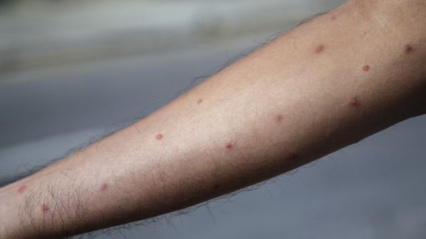 Pese a no tener casos confirmados, Gobierno de México emite aviso por viruela del mono