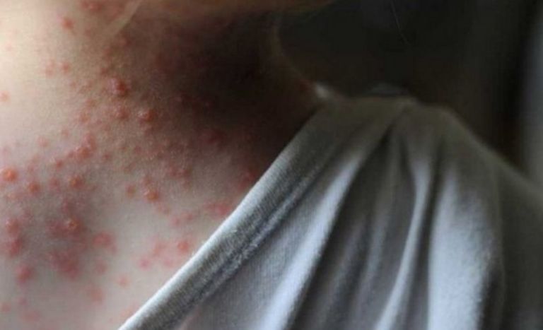 Confirman caso de viruela del mono en Argentina
