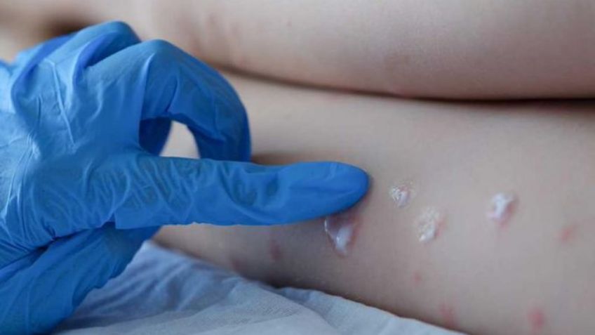 No lo descartan: Viruela del mono podría llegar a México según científicos de la UNAM