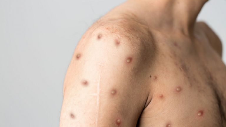 La viruela de mono no es una enfermedad exclusiva de la comunidad LGBT+