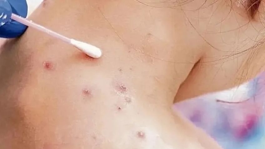 Casos de viruela del mono siguen en México; Sinaloa reporta un paciente con la enfermedad