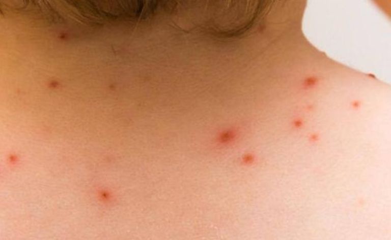 Confirman dos casos de viruela del mono en Nuevo León. Foto: Internet