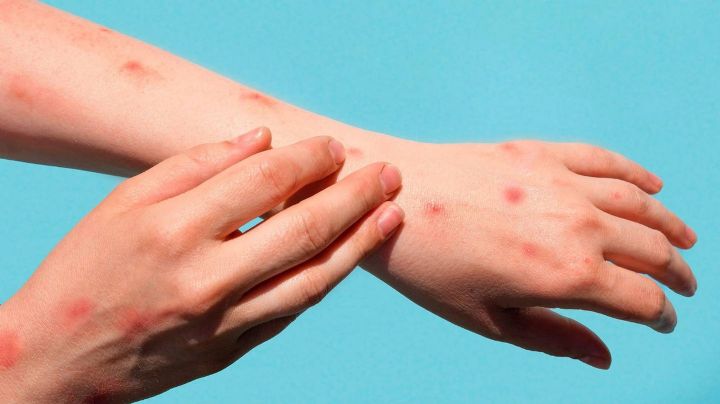 La viruela del mono supera los 15 mil casos a nivel mundial; la OMS considera declararla pandemia