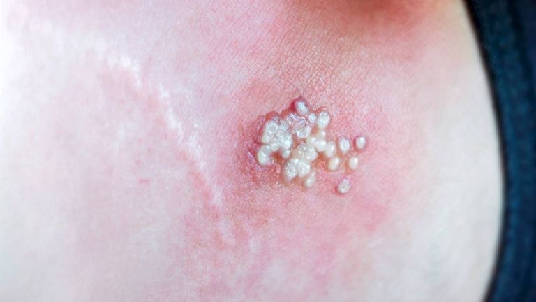 Confirman 55 casos de viruela del mono en México