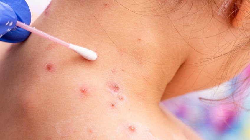Viruela del mono en México: Secretaría de Salud confirma 55 casos y amplia medidas preventivas