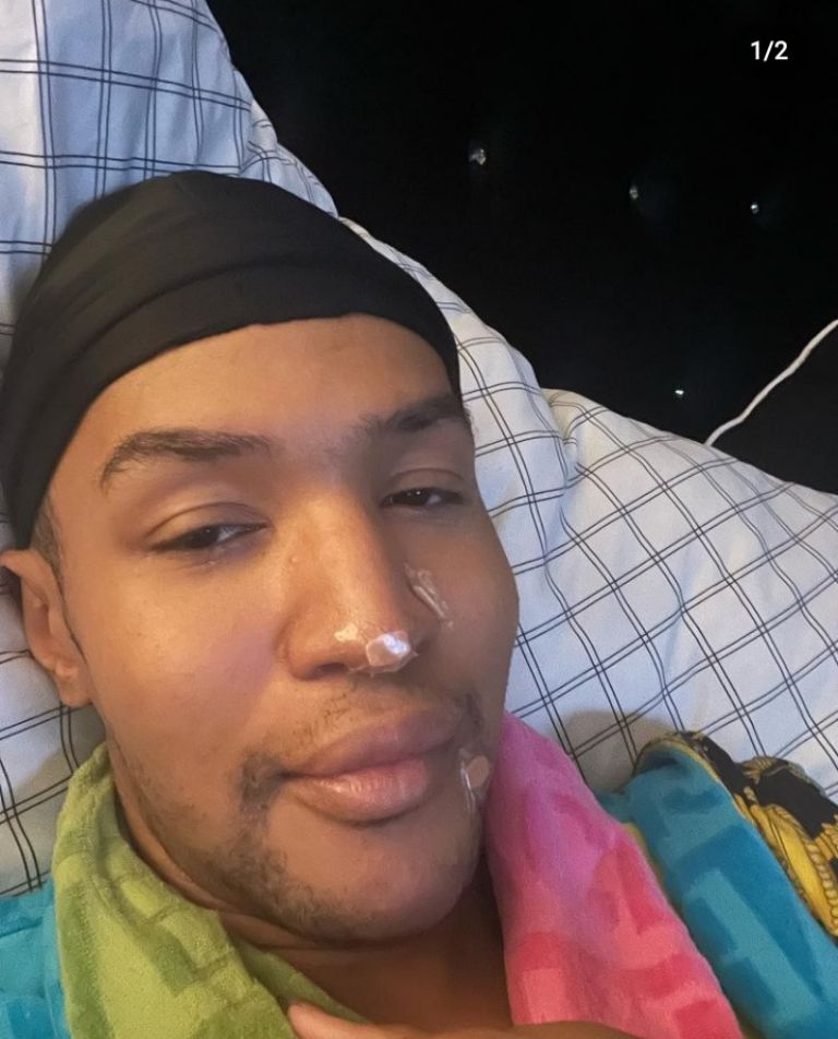 En la imagen, Trinity K. Bonet, paciente de viruela del mono. Foto: Instagram