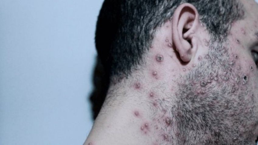 EU reporta su primera muerte por viruela del mono: Paciente estaba en Texas