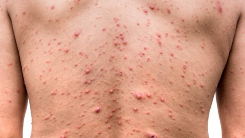 Buenas noticias: OMS reporta descenso en contagios de viruela del mono en varios países