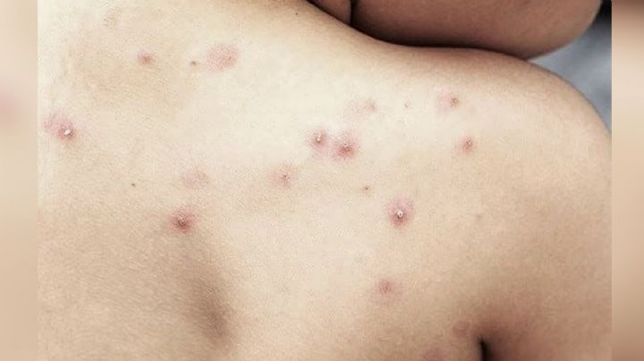 Pacientes con viruela símica en Sonora ya fueron dados de alta, afirma SSA