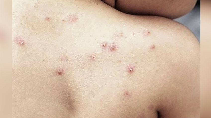 Pacientes con viruela símica en Sonora ya fueron dados de alta, afirma SSA