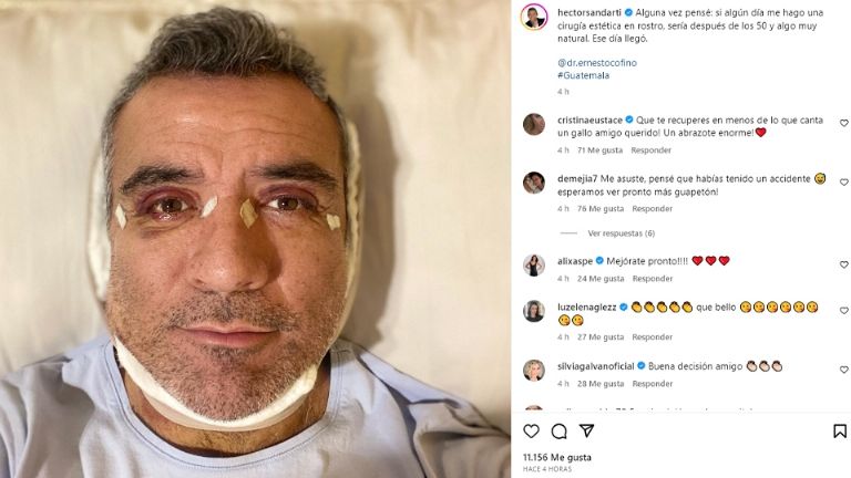 Héctor Sandarti se sometió a cirugía estética