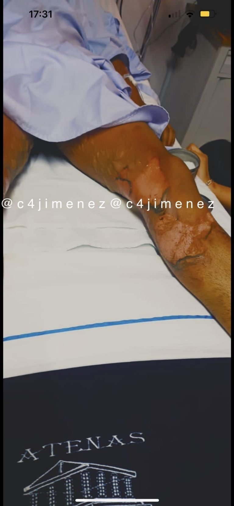 Estudiante en Texcoco Sufre Ataque Brutal: Rociado con Gasolina y Prendido en Fuego por Compañeros